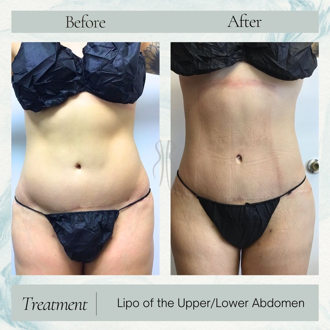 Lipo of Upper and Lower Abs